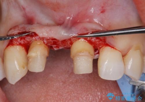 外れやすい前歯のブリッジ しっかりとした治療を受けたいの治療中