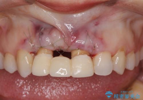 外れやすい前歯のブリッジ　しっかりとした治療を受けたいの治療中