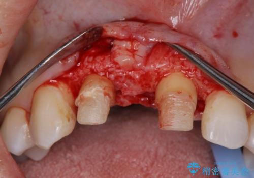 外れやすい前歯のブリッジ しっかりとした治療を受けたいの治療中