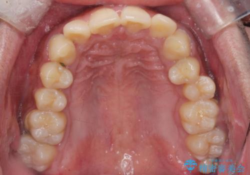 がたつきが気になる。インビザラインでスッキリ。の治療前
