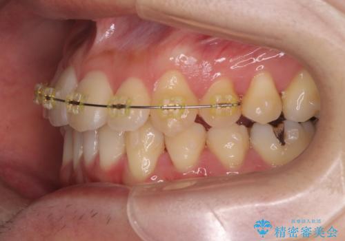 ねじれ・がたつきのある前歯を改善の治療中