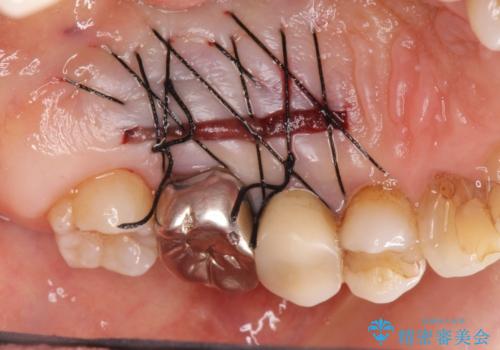 [ 根面被覆 ]  歯ぐきのさがりを移植で改善の治療中