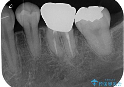目立つ銀歯をオールセラミッククラウンで自然に|20代女性の審美補綴症例の治療前