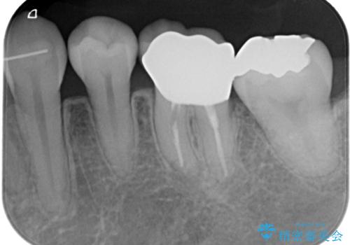 目立つ銀歯をオールセラミッククラウンで自然に|20代女性の審美補綴症例の治療後