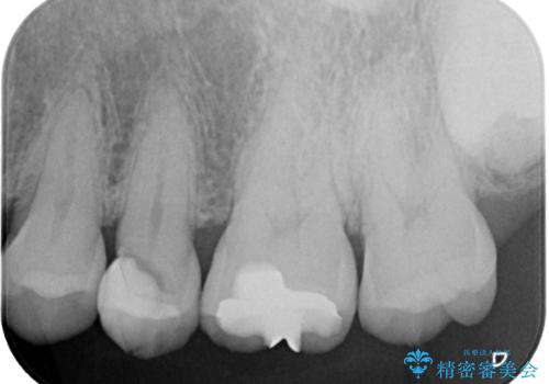 「やり替えるなら良いものを」精度重視の補綴治療を選択された症例の治療前