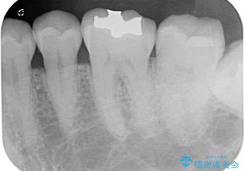 「やり替えるなら良いものを」精度重視の補綴治療を選択された症例の治療前