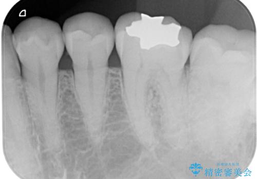 「やり替えるなら良いものを」精度重視の補綴治療を選択された症例の治療後