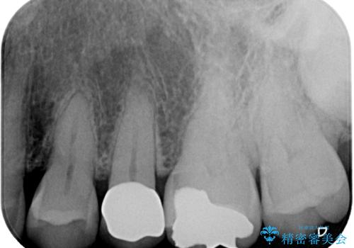 「やり替えるなら良いものを」精度重視の補綴治療を選択された症例の治療後
