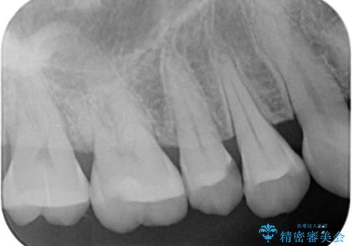 詰め物が欠けたまま放置は危険?見えにくい奥歯のトラブルに注意の治療前