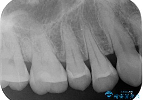 詰め物が欠けたまま放置は危険?見えにくい奥歯のトラブルに注意の治療後