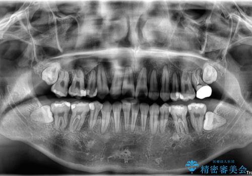 前歯のデコボコを抜歯矯正で改善した症例|目立ちにくい審美装置を使用の治療後