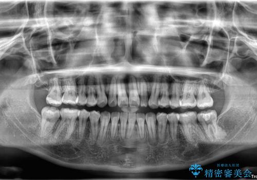 早く・確実に歯並び改善|目立ちにくいワイヤー矯正の治療後