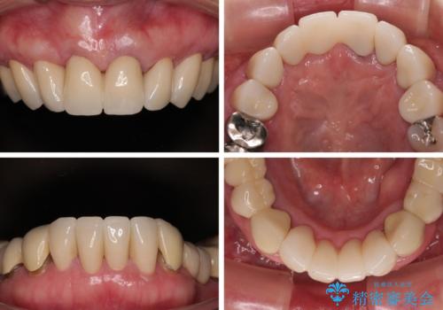 【海外から通院】統一感のない前歯をきれいに　オールセラミッククラウン治療の治療後