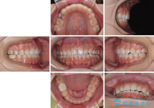 【モニター】デコボコとクロスバイトの前歯　ワイヤー装置での抜歯矯正の治療後