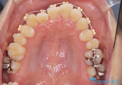 ねじれ・がたつきのある前歯を改善の治療中