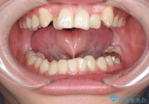 舌の動きを改善する舌小帯形成術の治療前