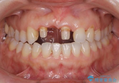 外れやすい前歯のブリッジ しっかりとした治療を受けたいの治療中