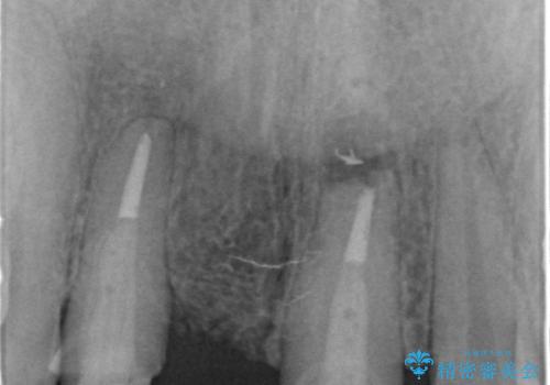 外れやすい前歯のブリッジ　しっかりとした治療を受けたいの治療中