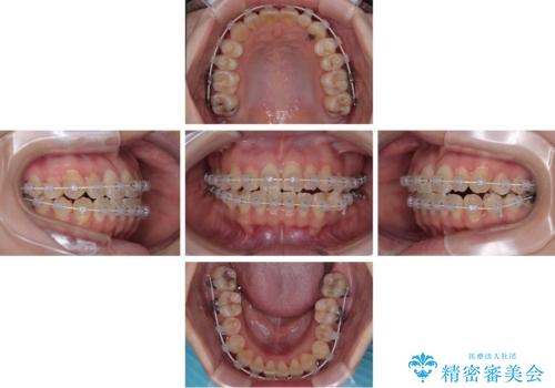 早く・確実に歯並び改善|目立ちにくいワイヤー矯正の治療中