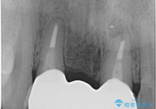 外れやすい前歯のブリッジ しっかりとした治療を受けたいの治療後