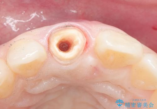 前歯の色が気になる。の治療中