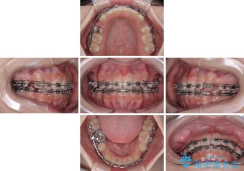 【モニター】デコボコとクロスバイトの前歯 ワイヤー装置での抜歯矯正の治療中