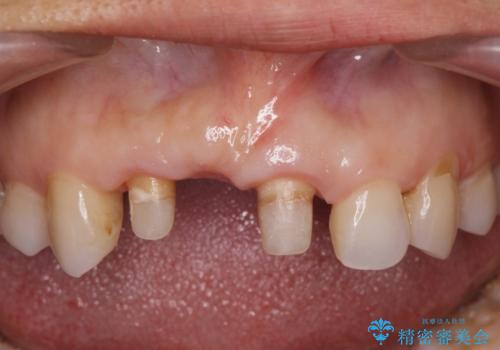 外れやすい前歯のブリッジ しっかりとした治療を受けたいの治療中
