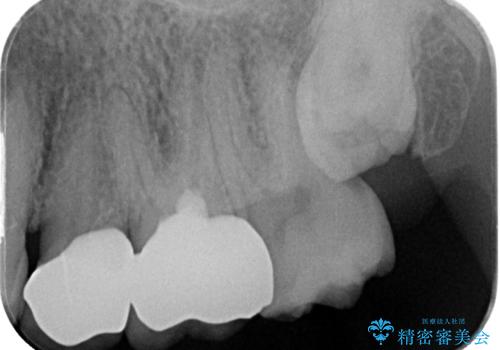 奥歯がたまにしみる MTAによる生活歯髄療法・オールセラミッククラウンの治療後