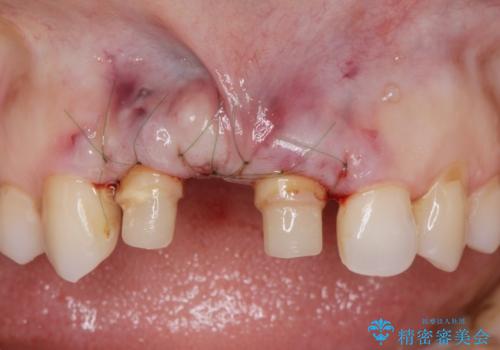 外れやすい前歯のブリッジ　しっかりとした治療を受けたいの治療中