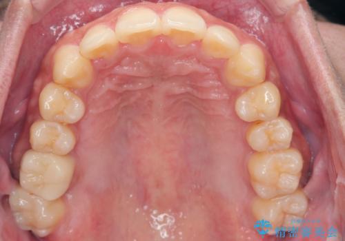 がたつきが気になる。インビザラインでスッキリ。の治療後