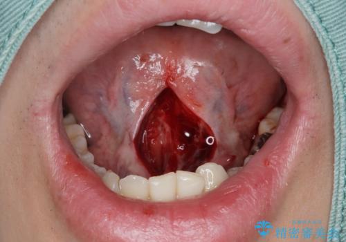 舌の動きを改善する舌小帯形成術の治療中