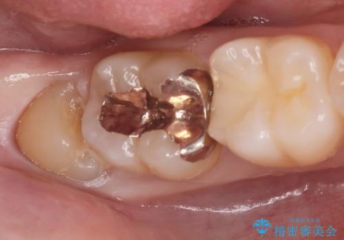 親知らずを抜きたいの症例 治療前