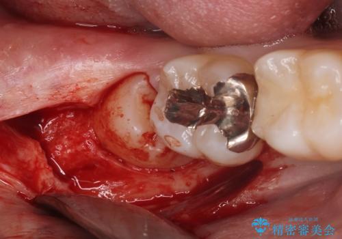 親知らずを抜きたいの治療中