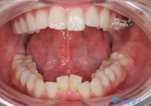 滑舌を良くしたい。の症例 治療後