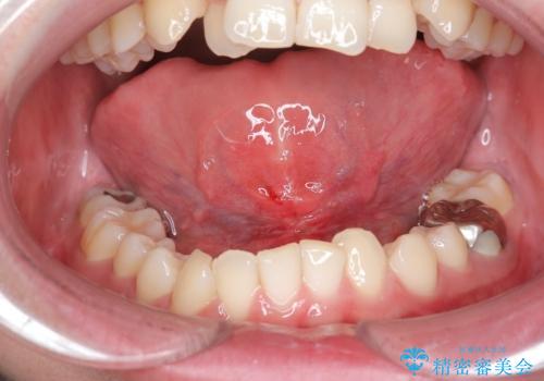 舌の動きを改善する舌小帯形成術の治療後