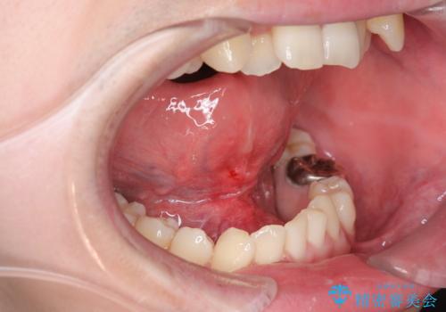 舌の動きを改善する舌小帯形成術の症例 治療後