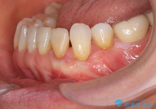 [ 根面被覆 ]  歯ぐきのさがりを移植で改善の治療後