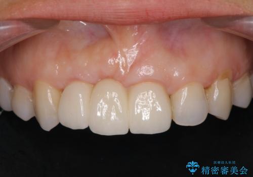 外れやすい前歯のブリッジ　しっかりとした治療を受けたいの治療後