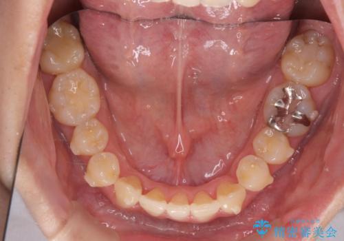 ねじれ・がたつきのある前歯を改善の治療中