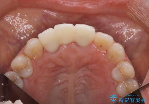 外れやすい前歯のブリッジ しっかりとした治療を受けたいの治療後