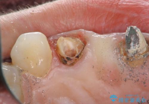 外れやすい前歯のブリッジ　しっかりとした治療を受けたいの治療前