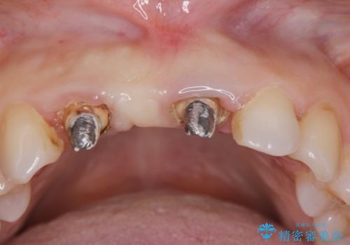 外れやすい前歯のブリッジ　しっかりとした治療を受けたいの治療前