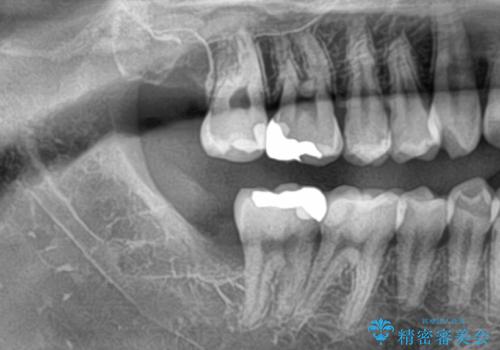 親知らずを抜きたいの治療後