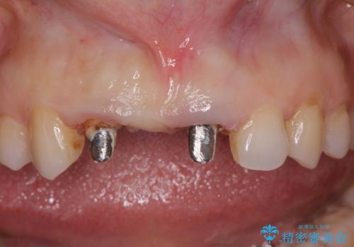 外れやすい前歯のブリッジ　しっかりとした治療を受けたいの治療前