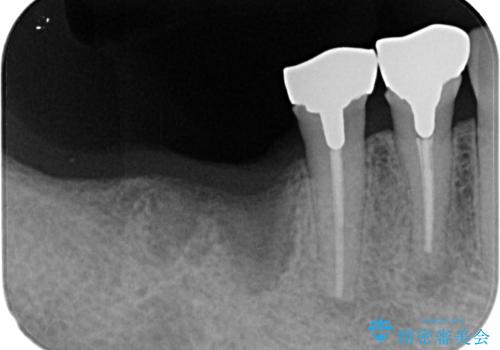 他院で抜歯をしたのでインプラントを入れたい インプラント治療の治療前