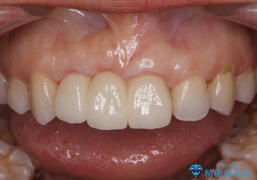 外れやすい前歯のブリッジ しっかりとした治療を受けたいの治療後