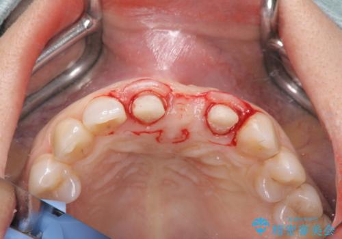 外れやすい前歯のブリッジ しっかりとした治療を受けたいの治療後