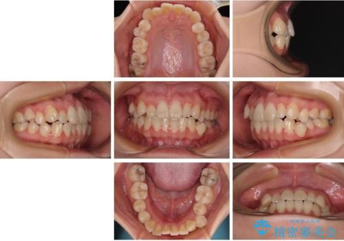 早く・確実に歯並び改善|目立ちにくいワイヤー矯正の治療前