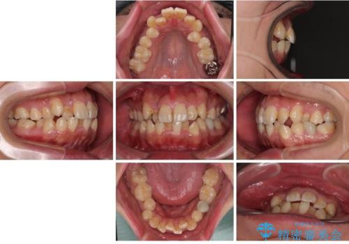 前歯のデコボコを抜歯矯正で改善した症例|目立ちにくい審美装置を使用の治療前