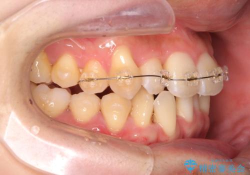 ねじれ・がたつきのある前歯を改善の治療中